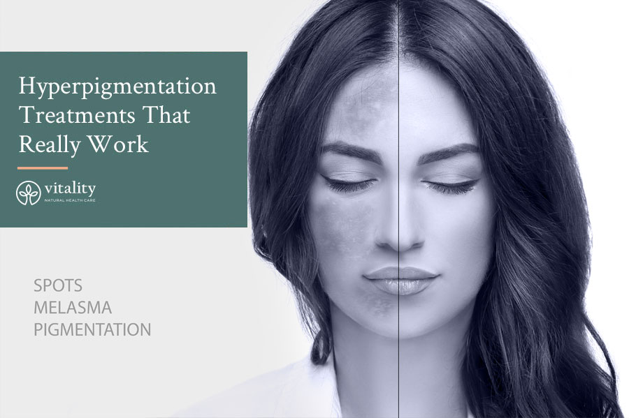 A Look At Hyperpigmentation Treatments That Really Work Image