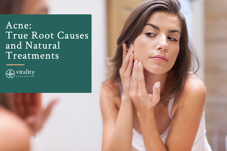 Acne Root Cause Natural Treatments