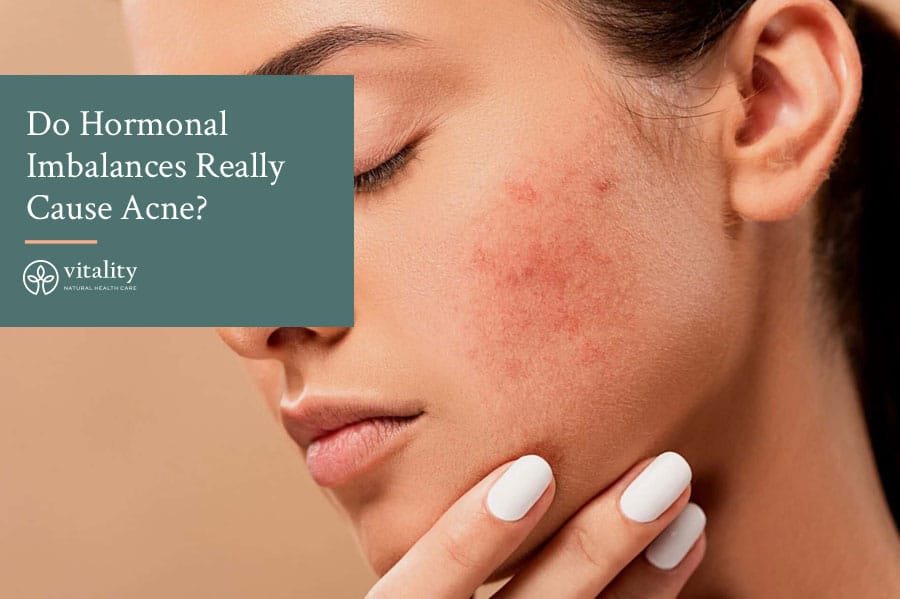 Do Hormonal Imbalances Really Cause Acne?