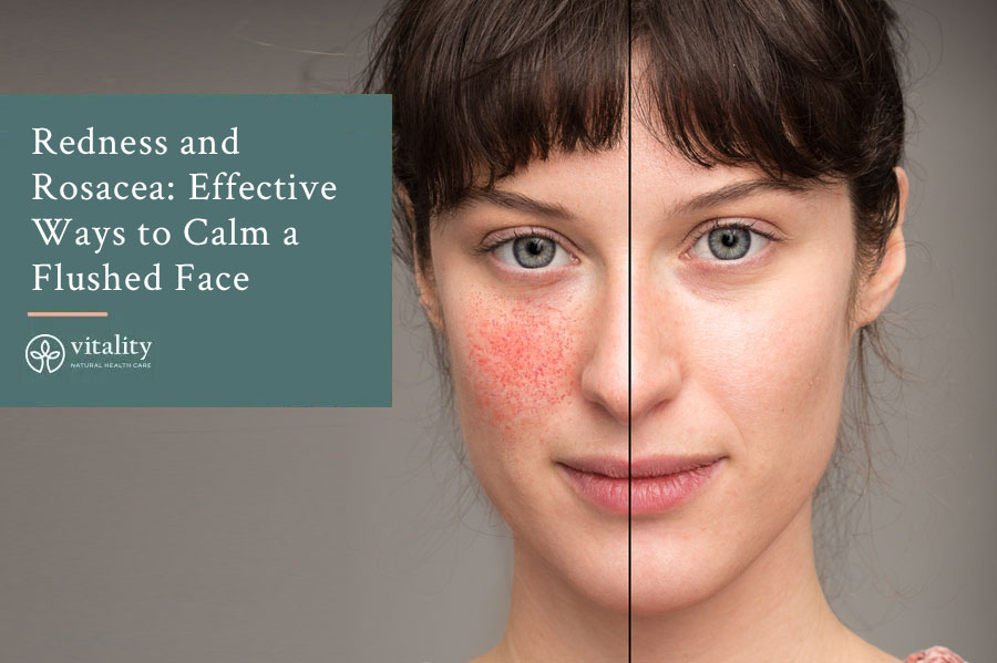 Redness And Rosacea Effective Ways To Calm A Flushed Face Img